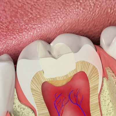 Скільки часу пломбувати зуб
